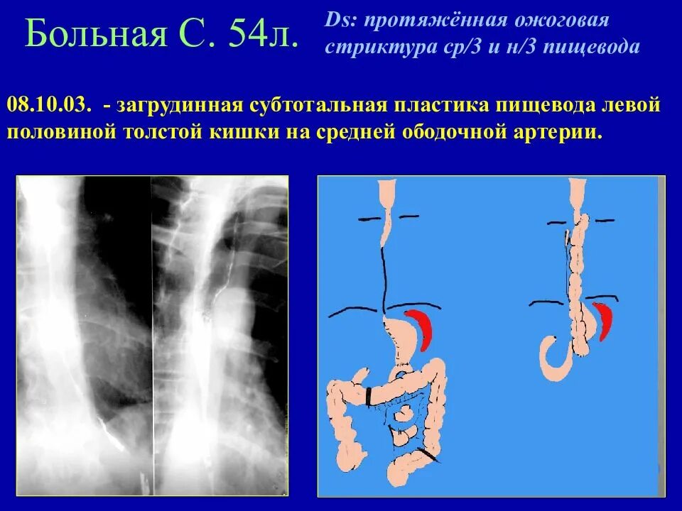 3 пищевода. Загрудинная пластика пищевода. Пластика пищевода кишкой. Пластика пищевода толстой кишкой.