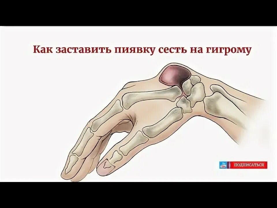 Гигрома лучезапястного сустава кисти: причины, симптомы, лечение. Как лечить гиг