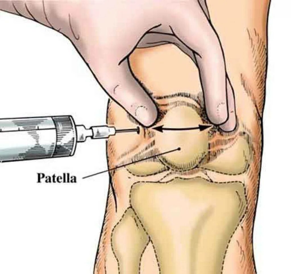Точки пункции коленного сустава. Техника внутрисуставной инъекции в коленный сустав. Техника пункции коленного сустава топографическая анатомия. Пункция коленного сустава техника точки.