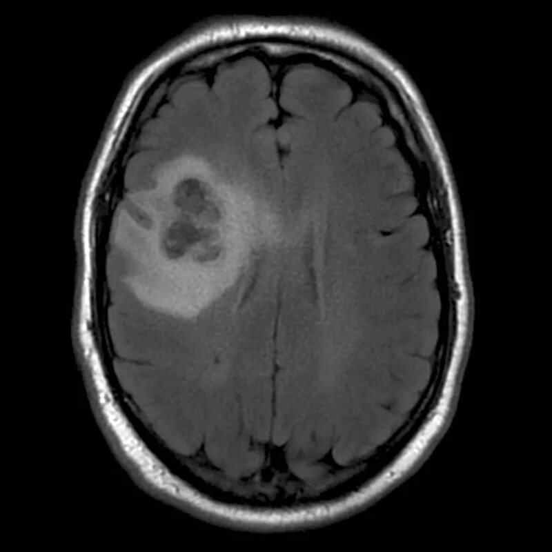Опухоль мозга глиобластома. Глиобластома головного мозга мрт. Глиобластома головного мозга на кт.