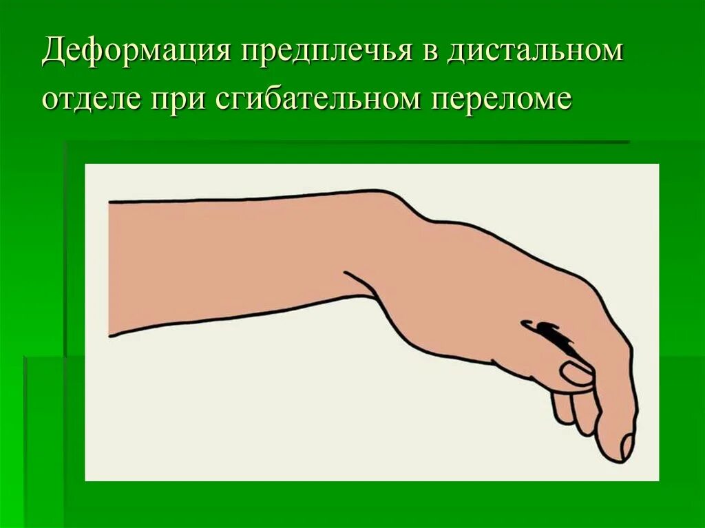 Деформация предплечья. Штыкообразная деформация. штыкообразная деформация предплечья. вилкообразная деформация предплечья.