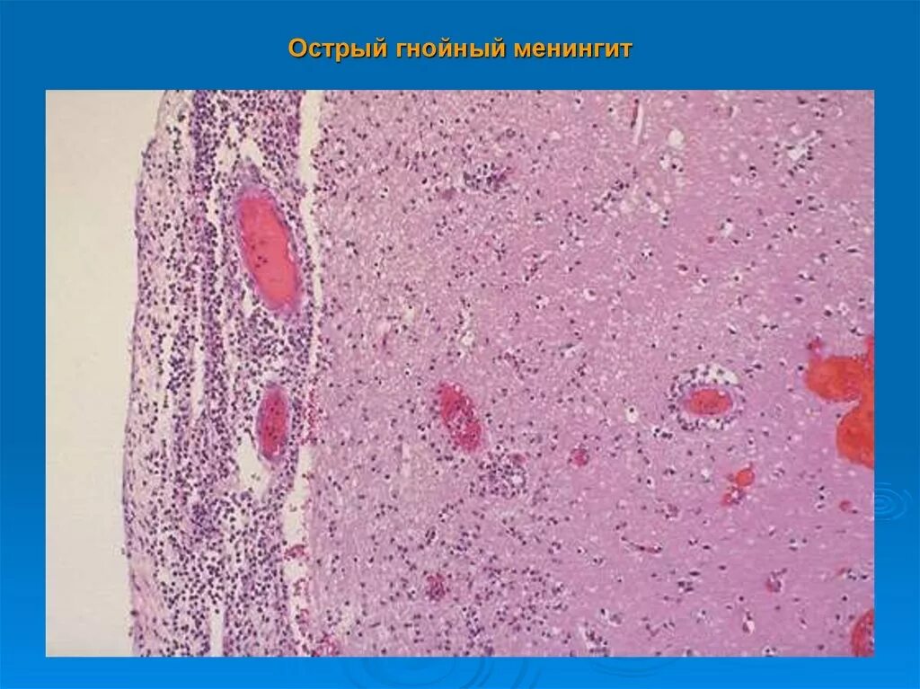 Гнойный менингит микропрепарат. Гнойный менингоэнцефалит гистология. Гнойный менингит микропрепарат патанатомия. Гнойный менингит макропрепарат патанатомия. Гнойный мозг