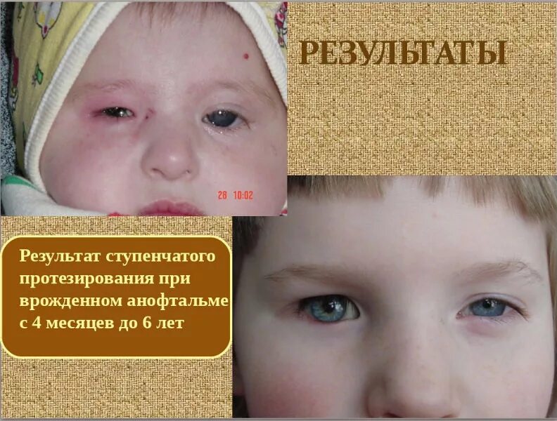 Анофтальм. Врожденный микрофтальм. микрофтальмия глаза у детей что это. микрофтальм и нанофтальм.