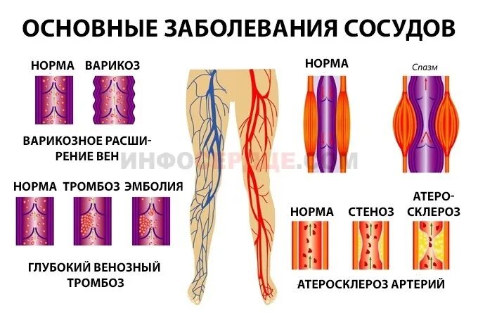 Заболевания артерий вен