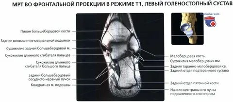 Связки голеностопного сустава мрт