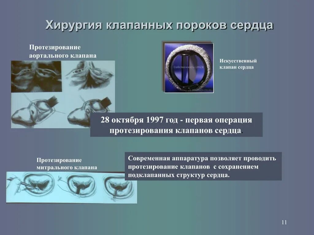 Конусная пластика трикуспидального клапана. Двухстворчатый клапан аорты. Аортальный клапан операция отзывы. Сердце операция митральный клапан. Аортальная недостаточность 2 степени.