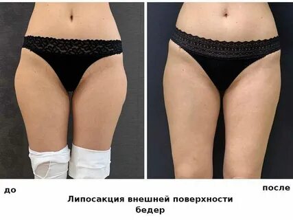 Липосакция ног до и после