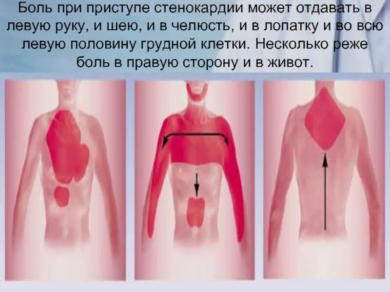 Иррадиация стенокардии. Локализация боли за грудиной. Боль в грудине посередине причины. Боль в грудной клетке посередине причины.