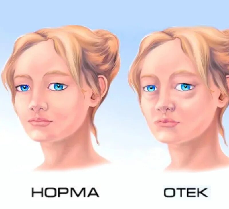 Как снять отек с утра. Пастозностьзность лица.