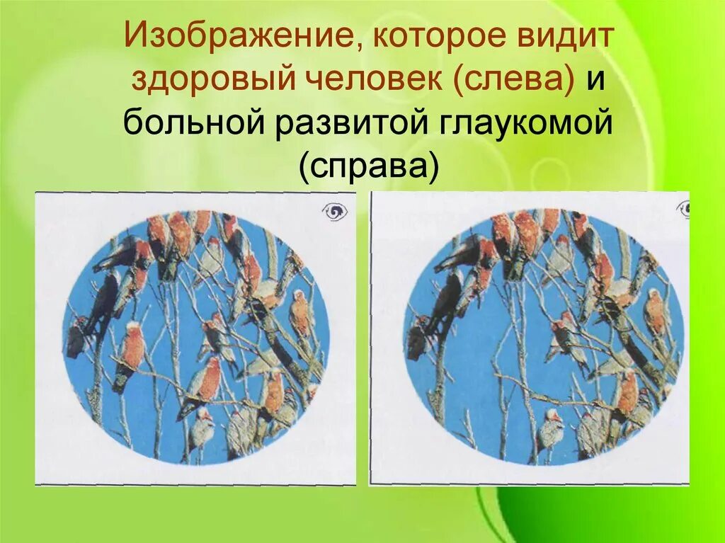 Как видит здоровый человек. Как видит человек с глаукомой. как видит больной глаукомой. как видит изображение больной глаукомой.