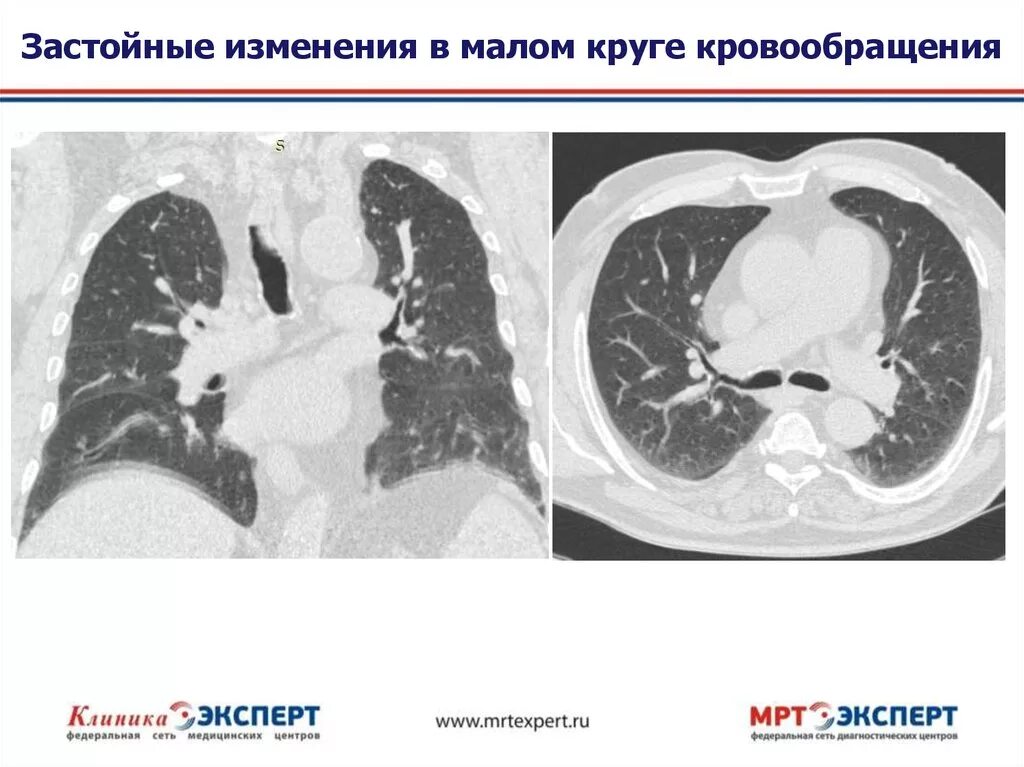 Гипостатические изменения кт. Застойные изменения в малом круге кровообращения. застойные явления в лёгких на кт. гипостатические изменения в легких на кт.