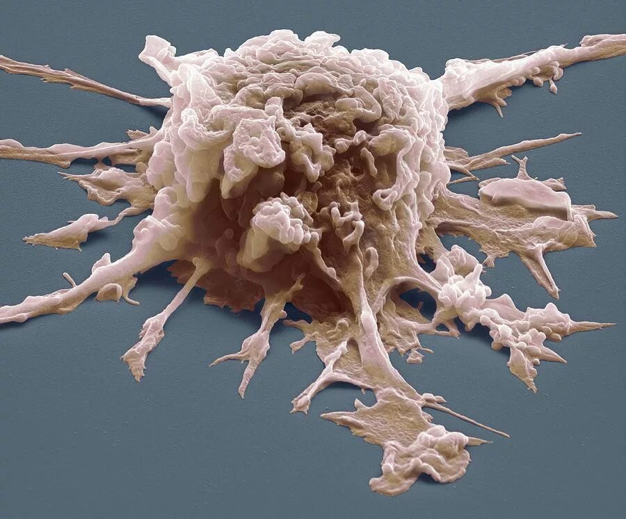 Макрофаги это лейкоциты. Макрофаг фагоцитоз бактерию. Макрофаг и раковая клетка. Макрофаги фагоцитоза иммунология. Макрофаги микробиология.