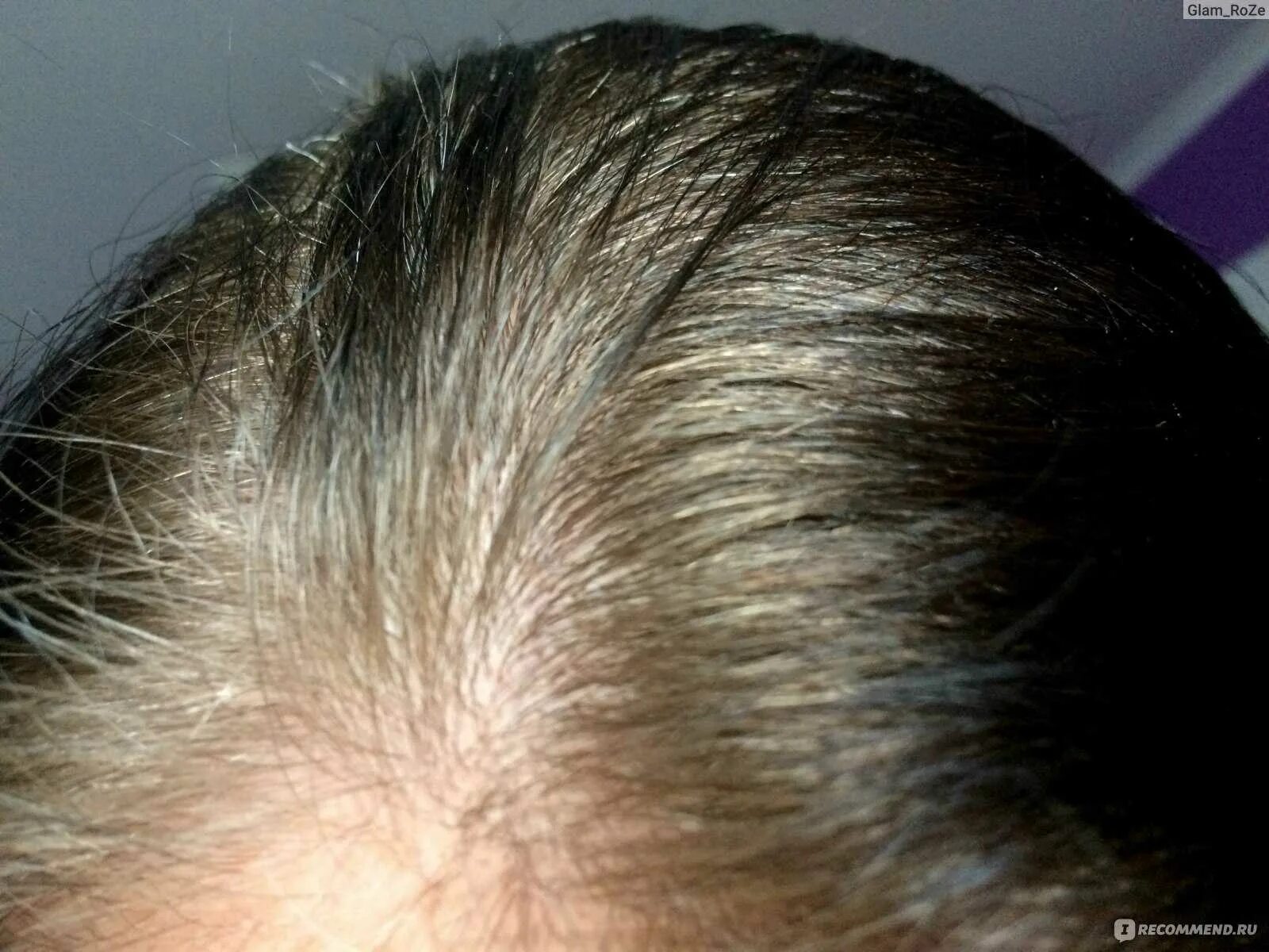 Остановить выпадение волос. Гормональное выпадение волос у женщин. Выпадение волос без луковицы.