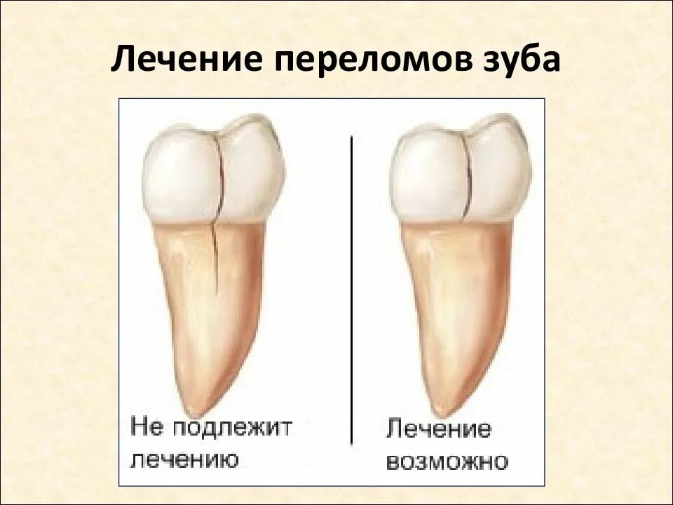 Продольный перелом стенки зуба. Вертикальный перелом зуба.