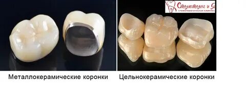 Что лучше металлокерамика или диоксид циркония коронки