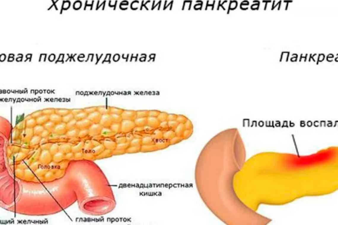 Панкреатит происхождение. Болезнь хронический панкреатит поджелудочной железы. Хроническое воспаление поджелудочной железы. Поражения поджелудочной железы иллюстрации. Симптомы хронического панкреатита поджелудочной железы.