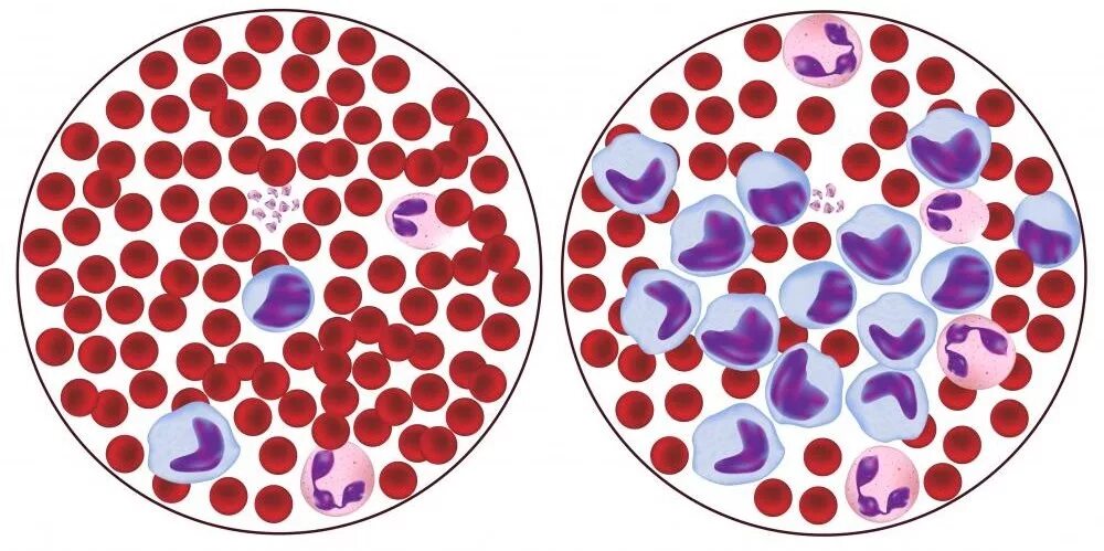 Эозинофилия картина крови. Эозинофилия периферической крови. Лимфоцитоз картина крови. Острый лейкоз мазок крови. Лимфопения крови