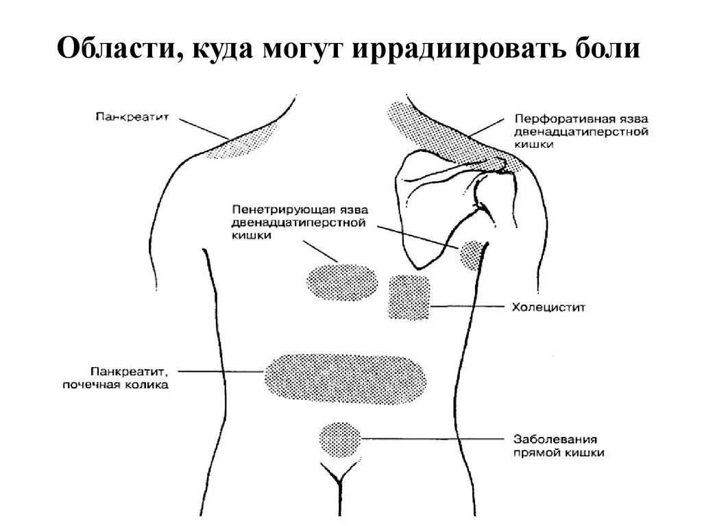 Острый панкреатит локализация боли. Иррадиация боли поджелудочной железы. Иррадиация боли при остром панкреатите. Локализация и иррадиация боли.