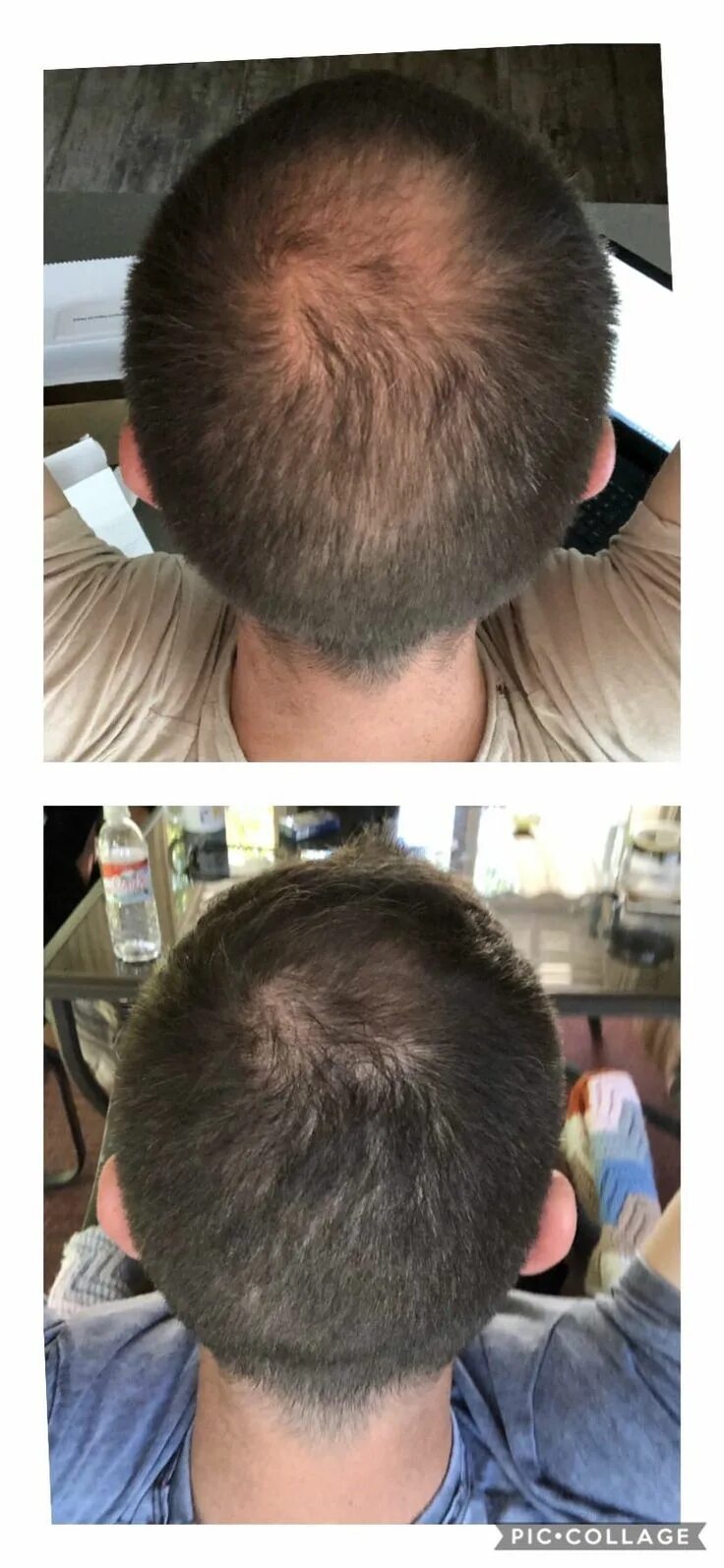 Миноксидил 3%. Как правильно миноксидил. Миноксидил 5 для волос. Миноксидил 30%. Миноксидил 15 для головы.