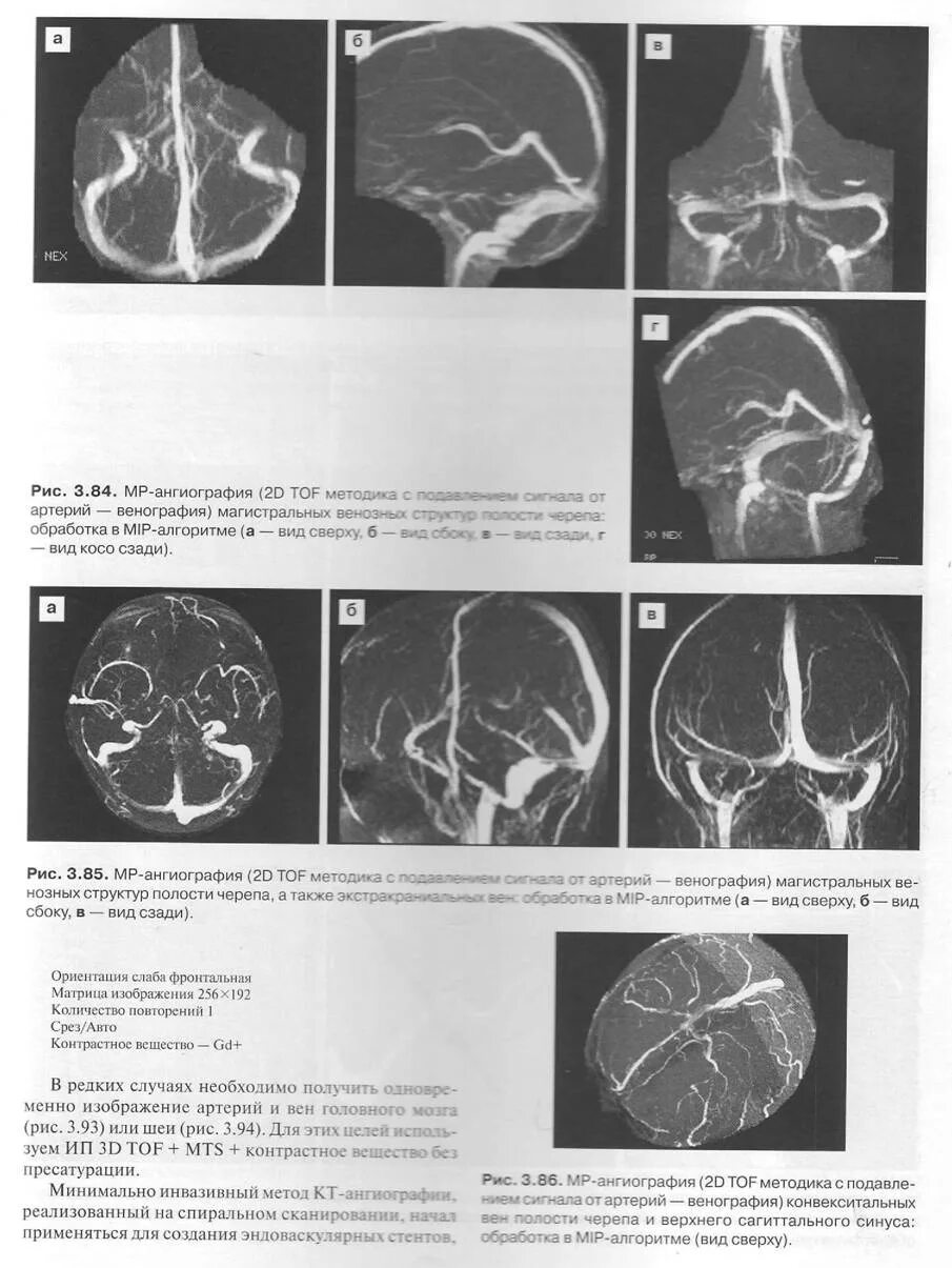 Венография головного мозга. МР-венография головного мозга. Ангиография и венография. Протокол кт ангиографии головного мозга. Венография головного мозга показания.