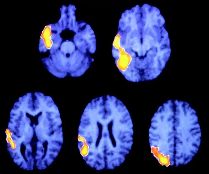 Очаги в коре головного мозга. Эпилептические очаги в головном мозге. Очаги эпилепсии в головном мозге. Очаги возбуждения в коре головного мозга. Мрт головного мозга эпилепсия.