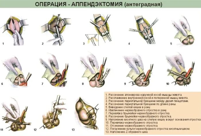 Что нельзя удаления аппендицита. Аппендэктомия этапы операции. Аппендэктомия ход операции. Антероградная и ретроградная аппендэктомия. Ретроградная аппендэктомия хирургия.