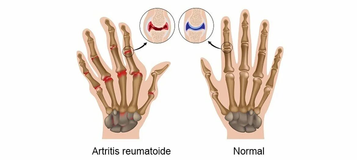 Боль в костях правой руки. Суставы кисти руки.