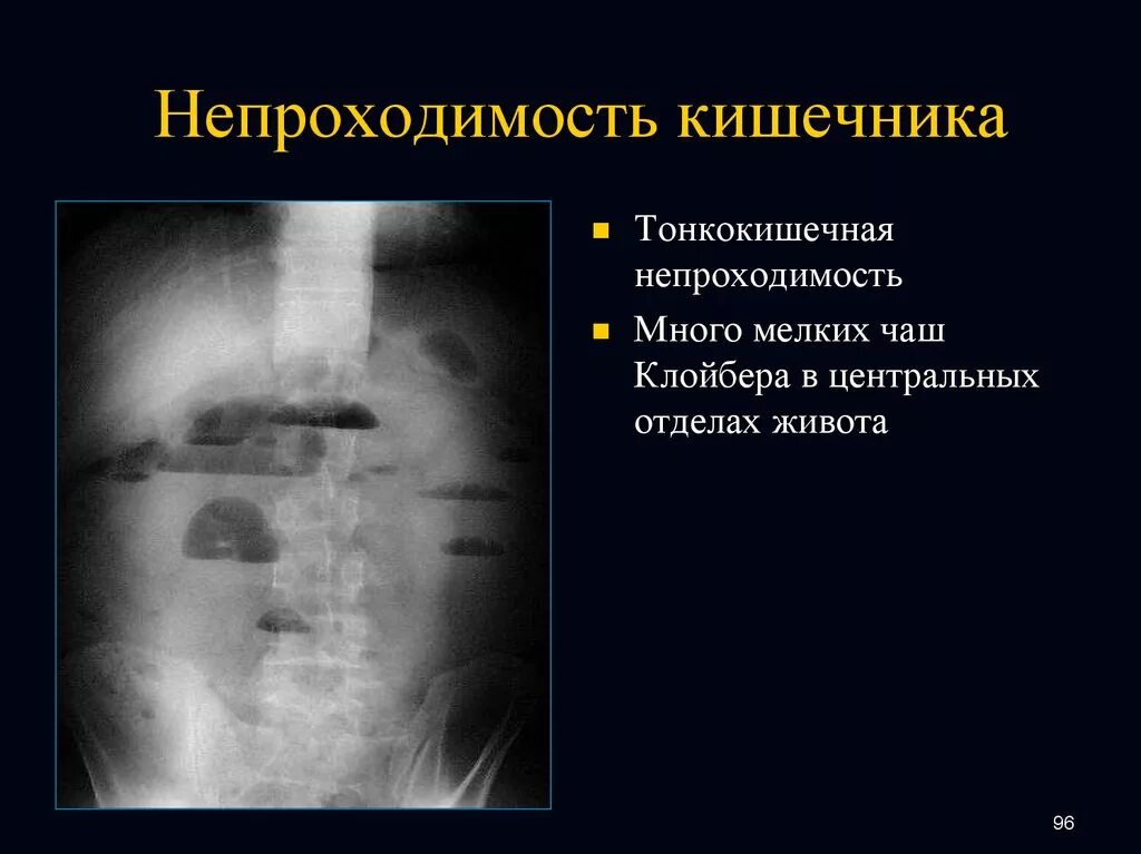 Симптом чаши. Кишечная непроходимость рентген чаши клойбера. описание рентгена при кишечной непроходимости. чаши клойбера на рентгенограмме у детей. механическая кишечная непроходимость рентген.