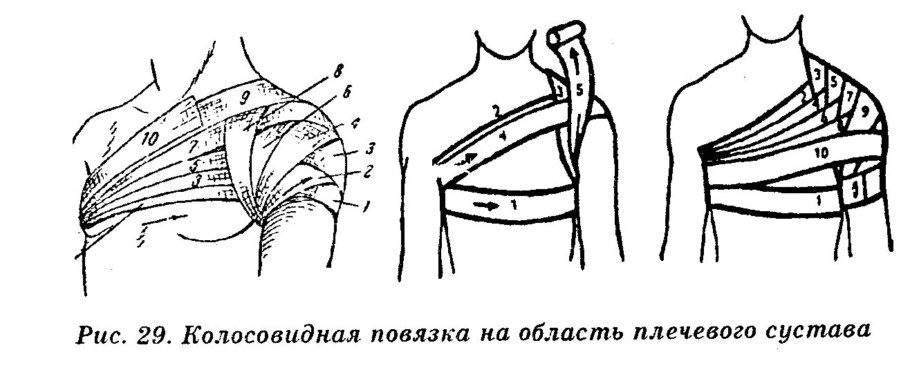 Плечевая повязка алгоритм. Перевязка колосовидная на плечо. Техника наложения колосовидной повязки на плечо. Колосовидная на область плечевого сустава. Колосовидная повязка на плечевой сустав повязка алгоритм.