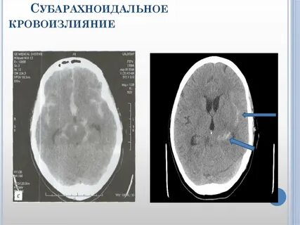 Субарахноидальное кровоизлияние головного