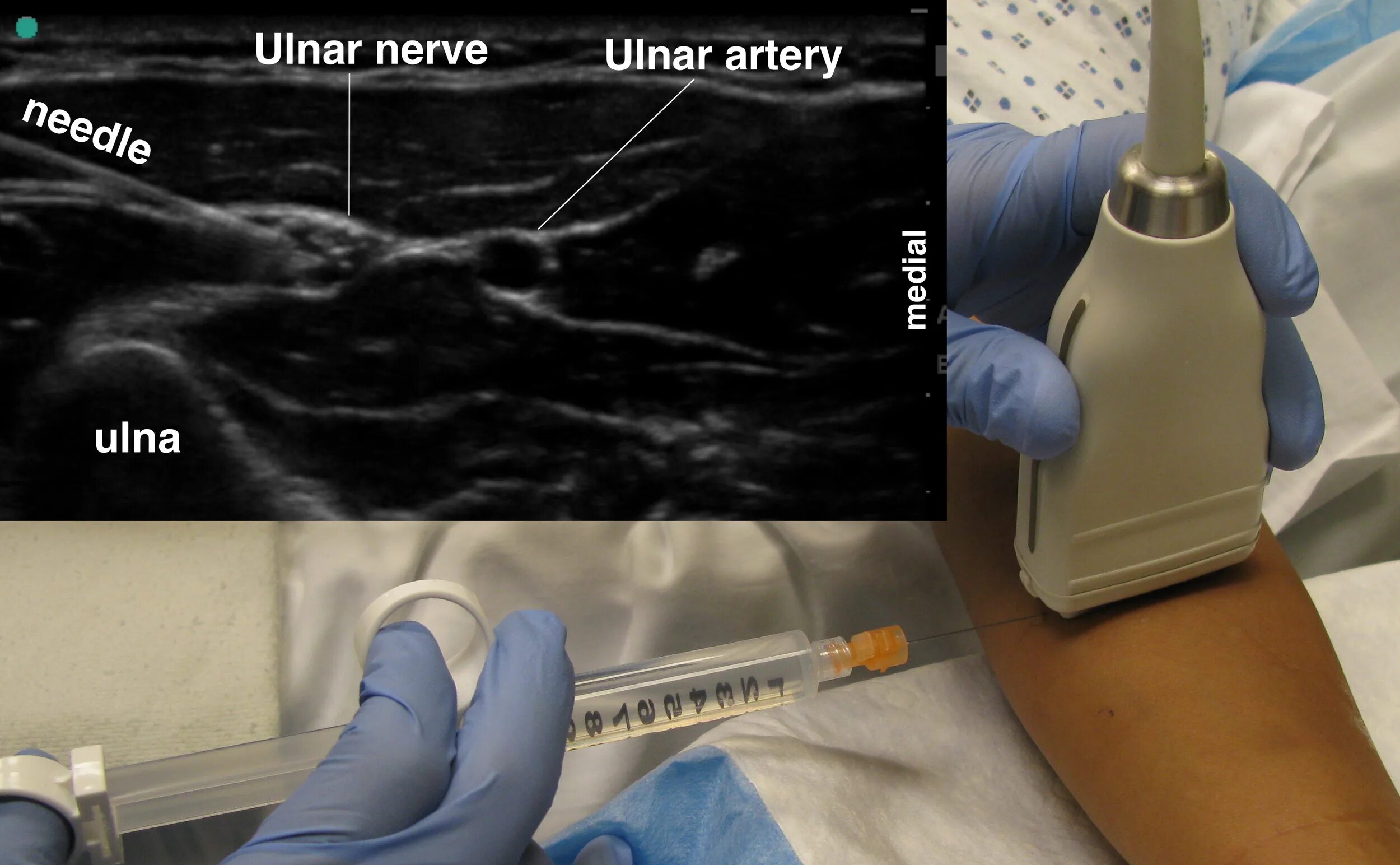 Блокада под узи. ЕМС ультразвук. Ультразвук ЕМС последняя. Ultrasound auriculotemporalis Block.