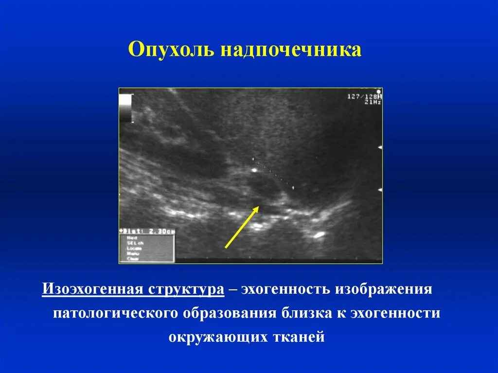 Аденома надпочечника на УЗИ. Изоэхогенное образование щитовидной железы УЗИ. УЗИ признаки опухоли надпочечника. Феохромоцитома надпочечника УЗИ.