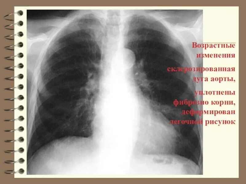 Рентген уплотнение корня лёгкого. Флюорография. Аорта уплотнена на флюорографии.