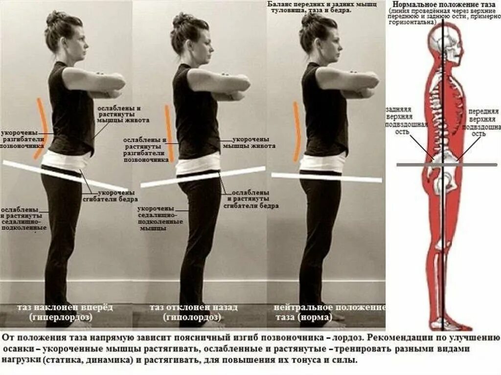 Передний наклон таза. Правильно положение таща. Упражнения для осанки. Правильная осанка. Изгиб плеча