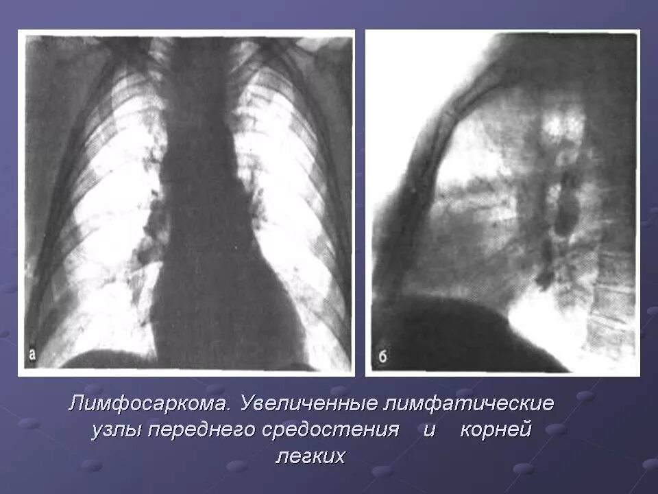 Увеличение корень легкого. Лимфосаркомапериферический лимфоузлов. Нодулярная лимфосаркома.