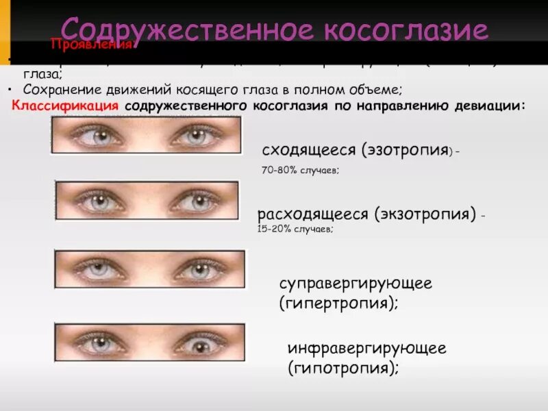 Классификация косоглази. Сходящееся содружественное косоглазие. Классификация косоглазия. Сходящееся косоглазие одного глаза. Косоглазие симптомы