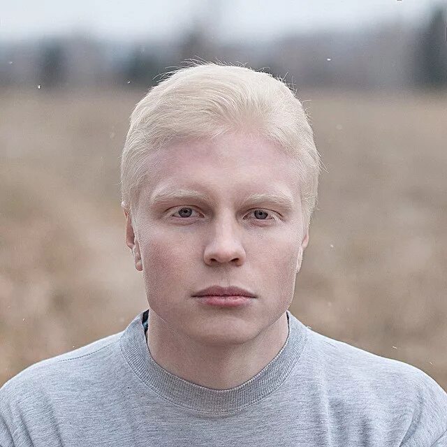 Саша Смирнов альбинос. Нордид альбинос.