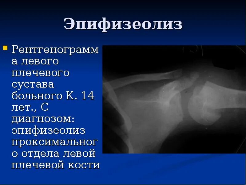 Плечевой сустав у детей. Эпифизеолиз (перелом салтера-харриса);. эпифизеолиз локтевого сустава рентген. эпифизеолиз лучевой кости рентген. эпифизеолиз головки плечевой кости.