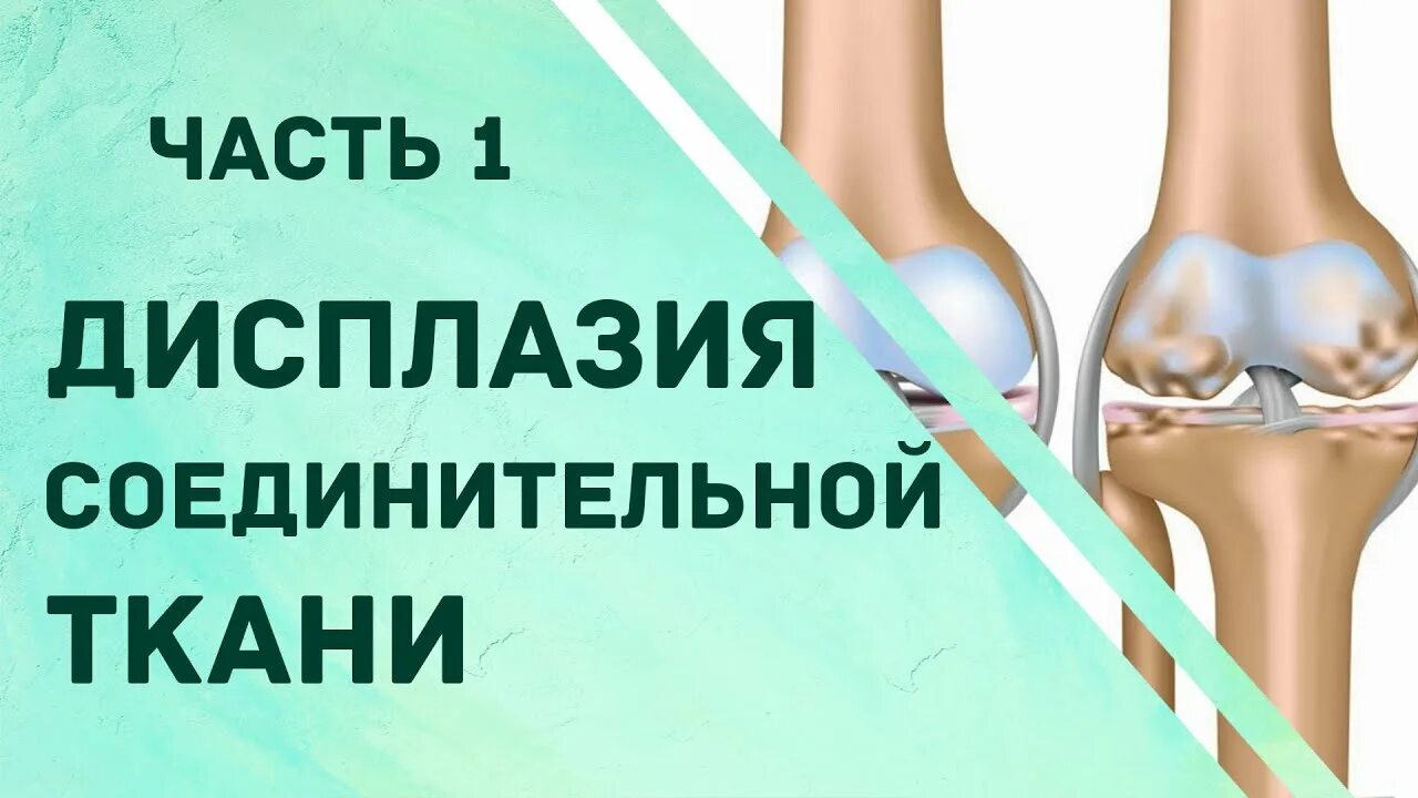 Дисплазия соединительной ткани. Повторная дисплазия. Врожденный вывих бедра рентген. Спондилоэпиметафизарная дисплазия. Повторная дисплазия.