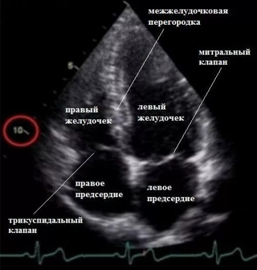 Левое предсердие норма. Узи сердца норма снимок. эхокардиография норма и патология. эхокардиография левое предсердие норма. анатомия сердце эхокардиография.