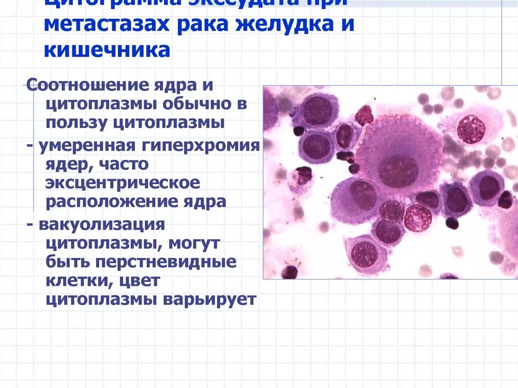 Метастазы отзывы пациентов