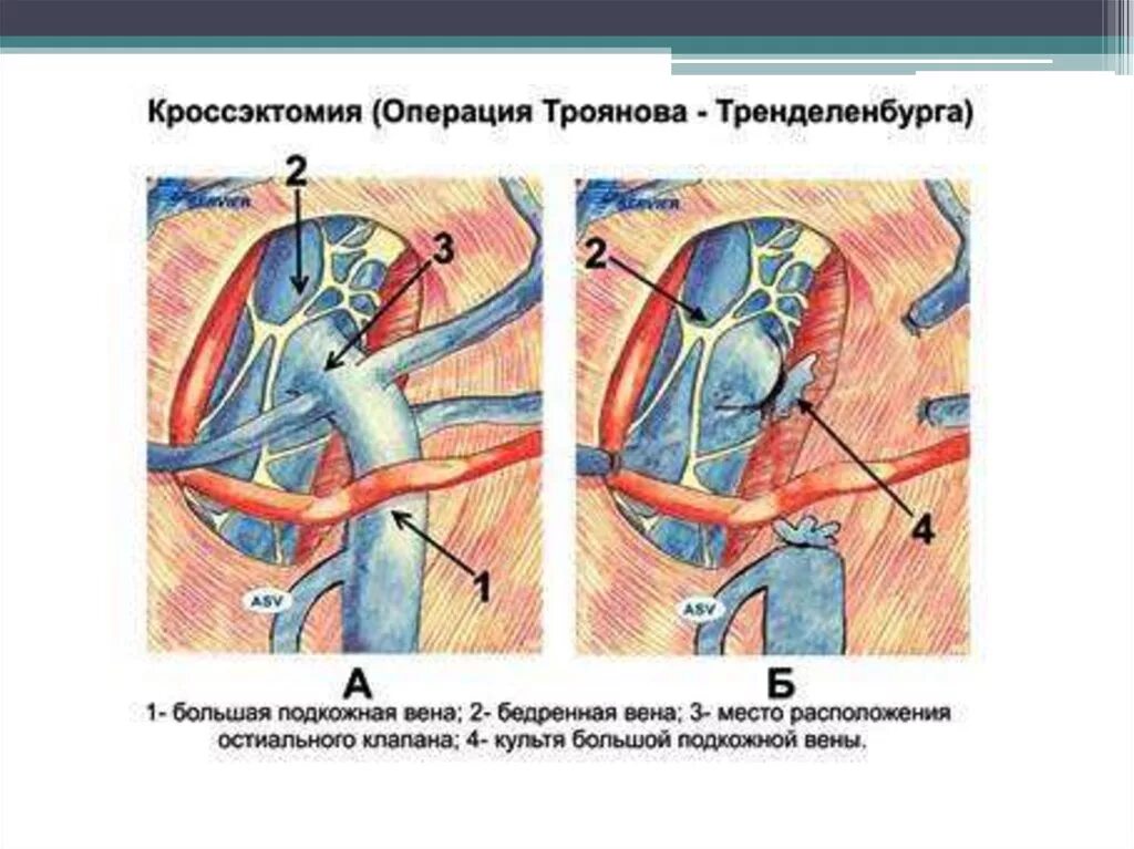 Операция Троянова-Тренделенбурга. Кроссэктомия операция Троянова Тренделенбурга. Бедренная Вена кроссэктомия. Операция Троянова-Тренделенбурга ход операции. Укажите внутренние операции