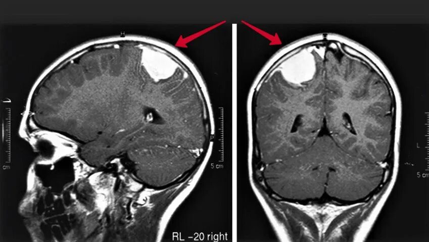 Менингиома лобной доли мрт. Менингиомы головного мозга на кт. Менингиома лобной доли кт. Опухоли гм