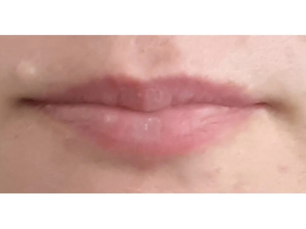 Усы над верхней губой после увеличения. Усы от гиалуроновой кислоты. Гиалуроновые усы над верхней губой.