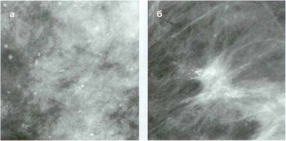 Округлые кальцинаты. Маммография микрокальцинаты. Кальцинаты на маммографии. Склерозирующий аденоз молочной железы на рентгене.