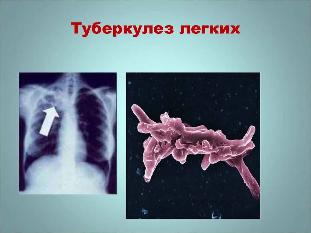 Палочка Коха туберкулез. Туберкулез презентация. Туберкулез слайд