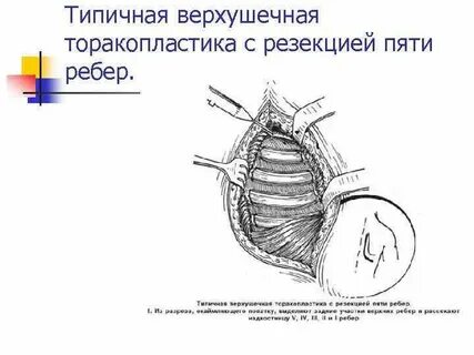 Торакопластика