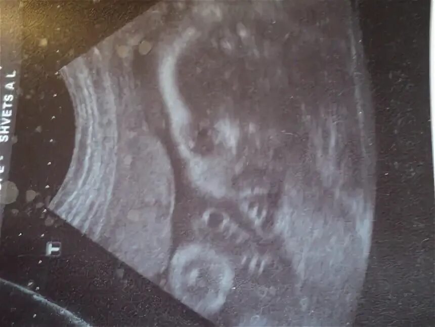 Беременность 34 недели родился. УЗИ 34 недели беременности. УЗИ 34 недели беременности фото. Снимок УЗИ на 34 неделе беременности.
