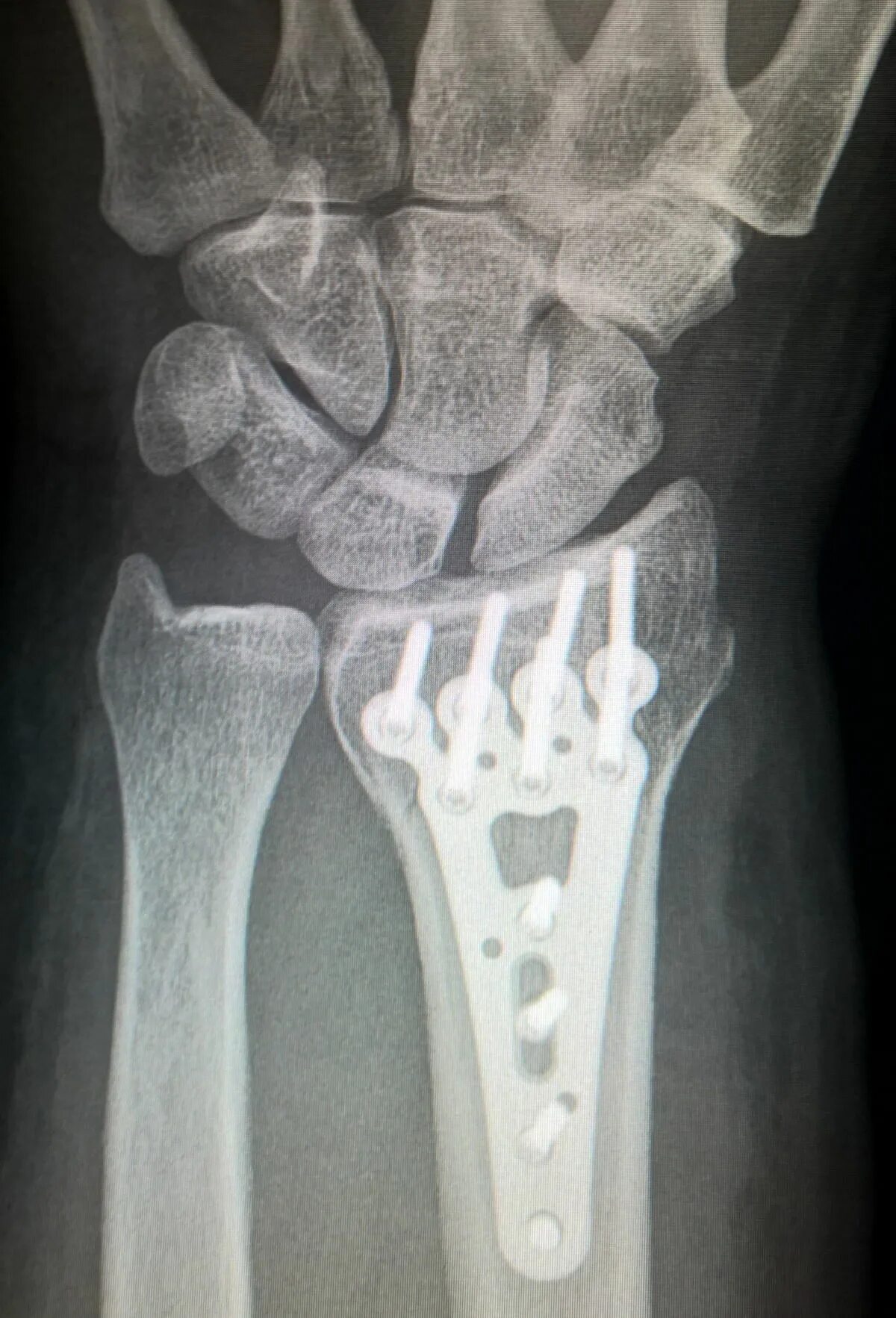 Титановая пластина на рентгене. Трещина лучевой кости рентген. Рентгенограмма перелом кости.