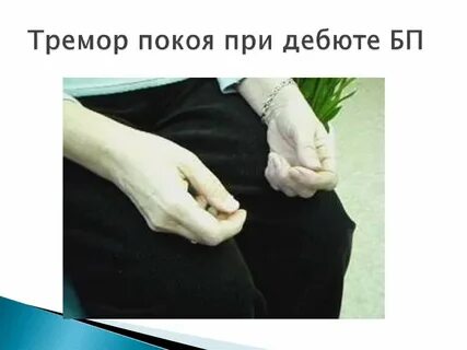 Тремор покоя причины